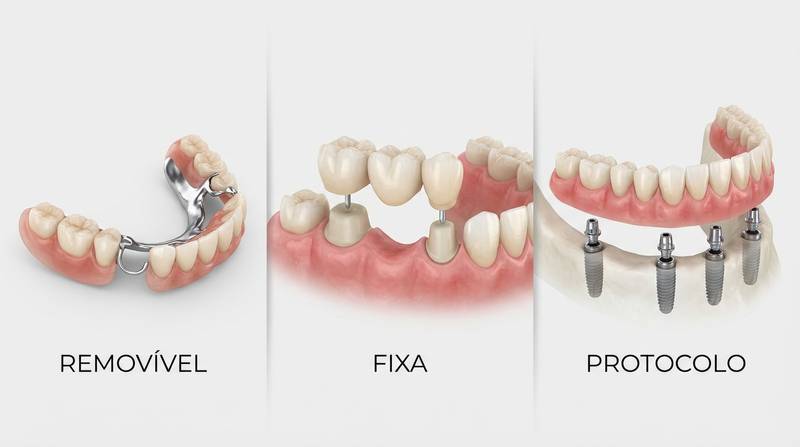 Prótese Dentária